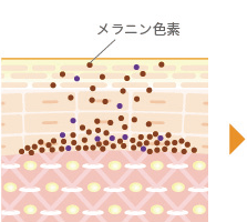 脱毛の流れステップ1